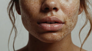 How To Get Rid of Hyperpigmentation Around Mouth - Imara Derma